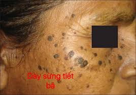 Dày sừng - Hình ảnh minh họa